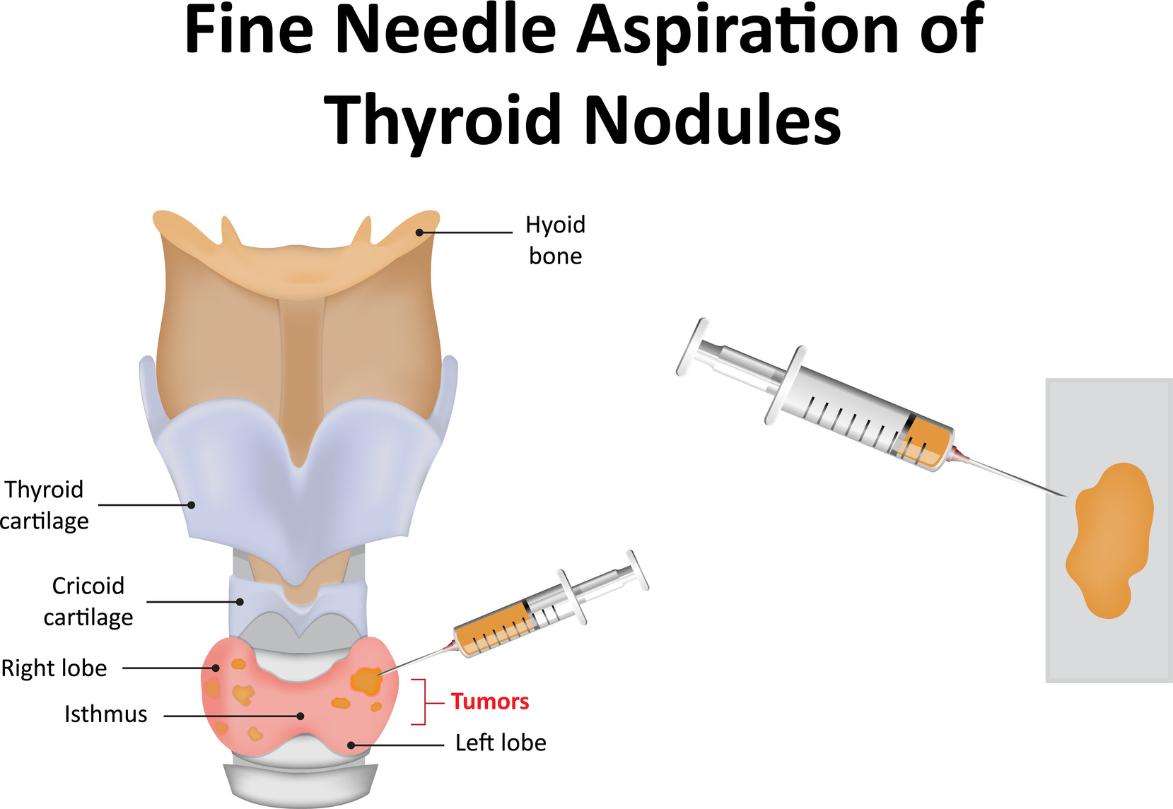 Illustration of fine needle aspiration of thyroid nodules