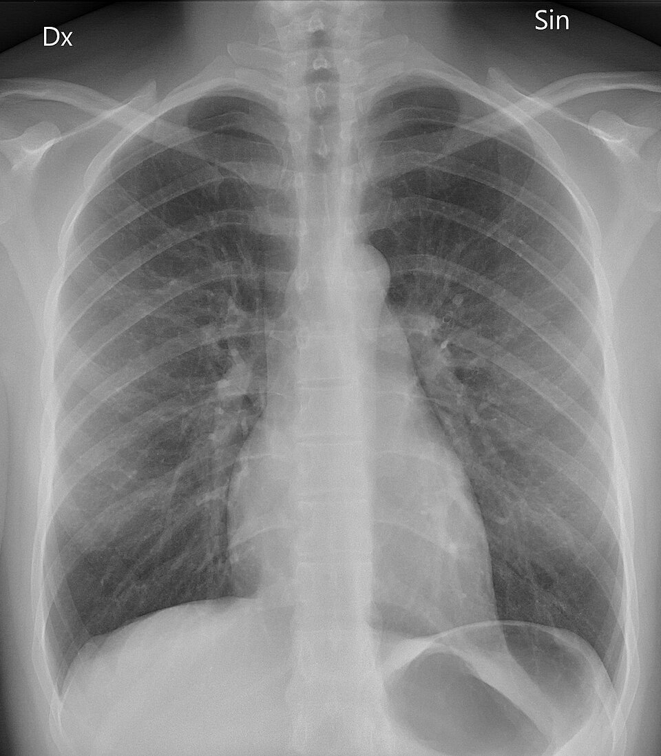 Chest X-ray radiograph
