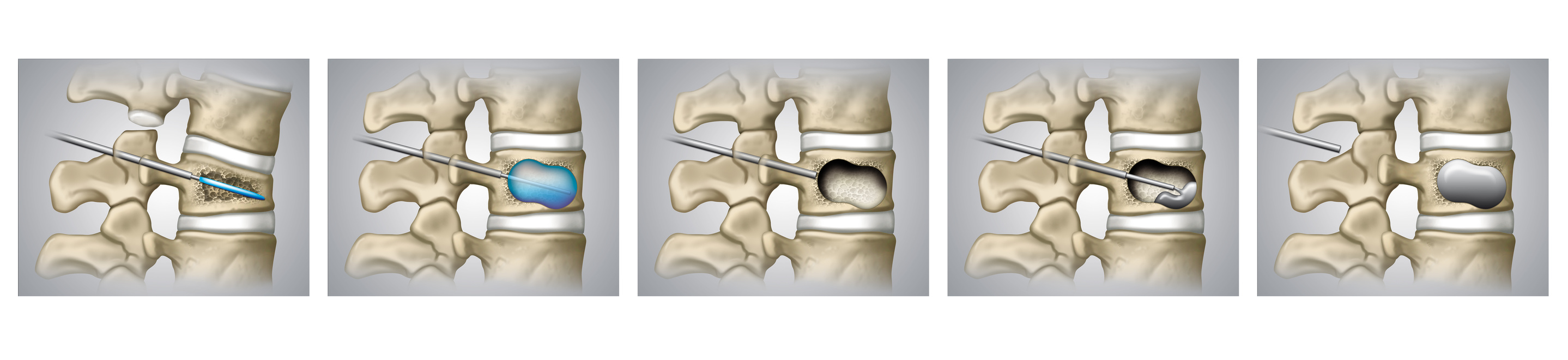 Balloon kyphoplasty illustration