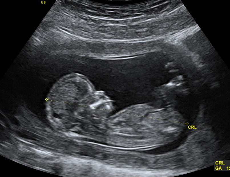 Ultrasound exam in progress