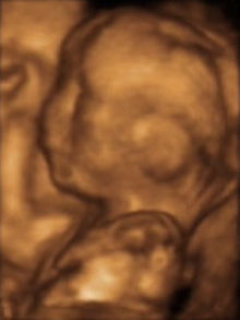 3D ultrasound image of a baby