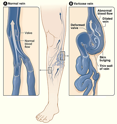 NIH diagram showing a normal vein versus a varicose vein