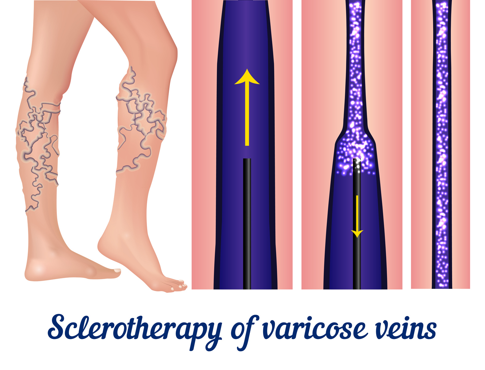 Varicose vein laser procedure