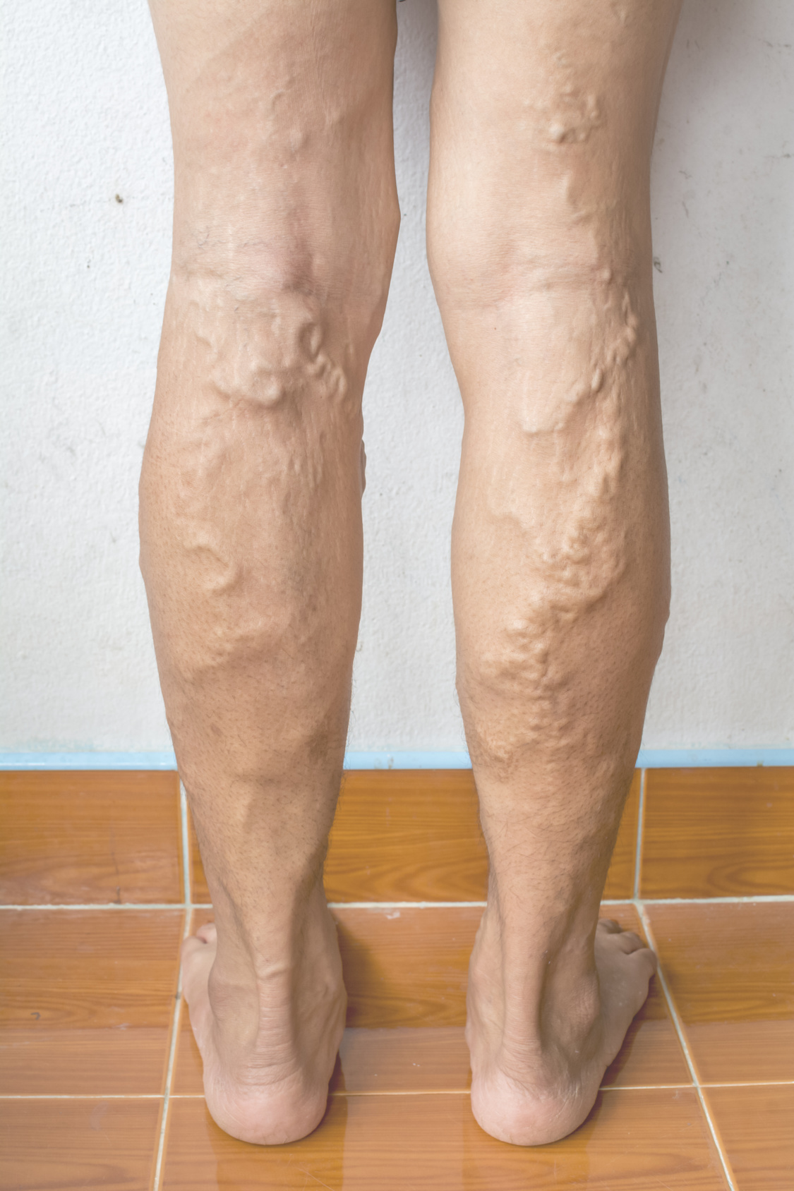 Legs affected by varicose veins